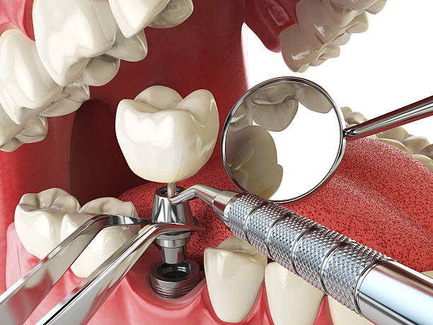 Best Emergency Dentist for Knocked-Out Tooth in Tulia, TX